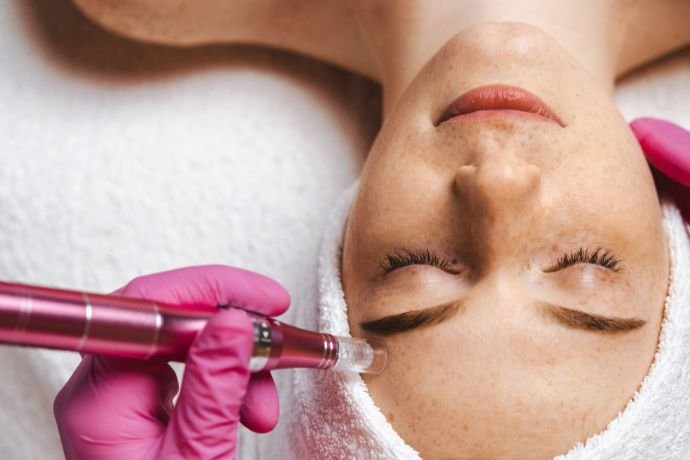 Microagulhamento Facial